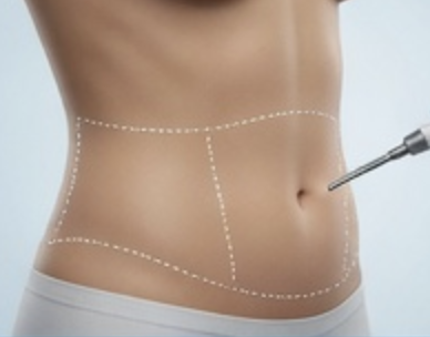 Liposuction of Abdomen and Waist